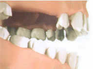 Отсутствие трех зубов на верхней челюсти.