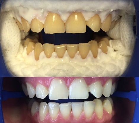 Изменение цвета зубов до и после отбеливания.