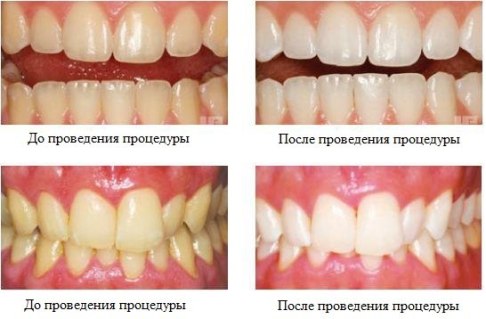 Изменение цвета зубов до и после домашнего отбеливания.