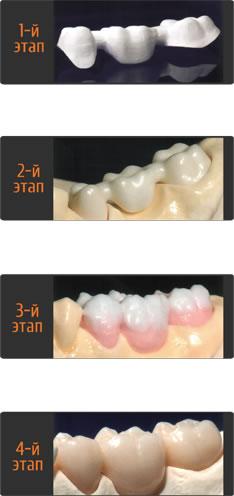 Этапы разработки протеза для зубов
