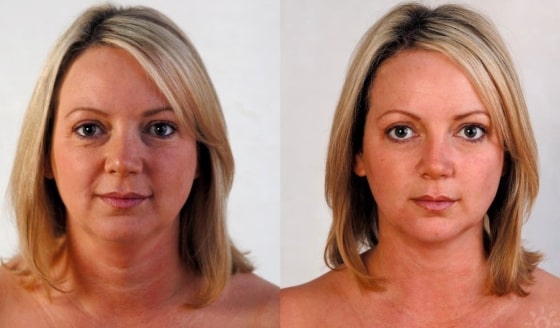 до и после подтяжки лица - фото 2