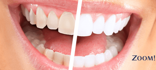 Фото до и после лазерного отбеливания зубов