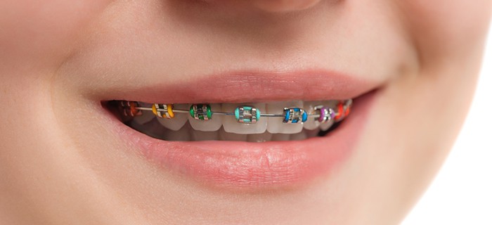 Брекеты, установленные на верхний ряд зубов.