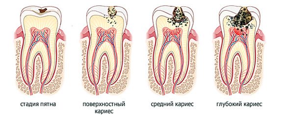 4 стадии кариеса зубов.