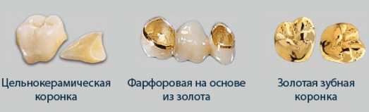Виды коронок на зубы