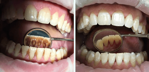 Фторирование зубов - До и После