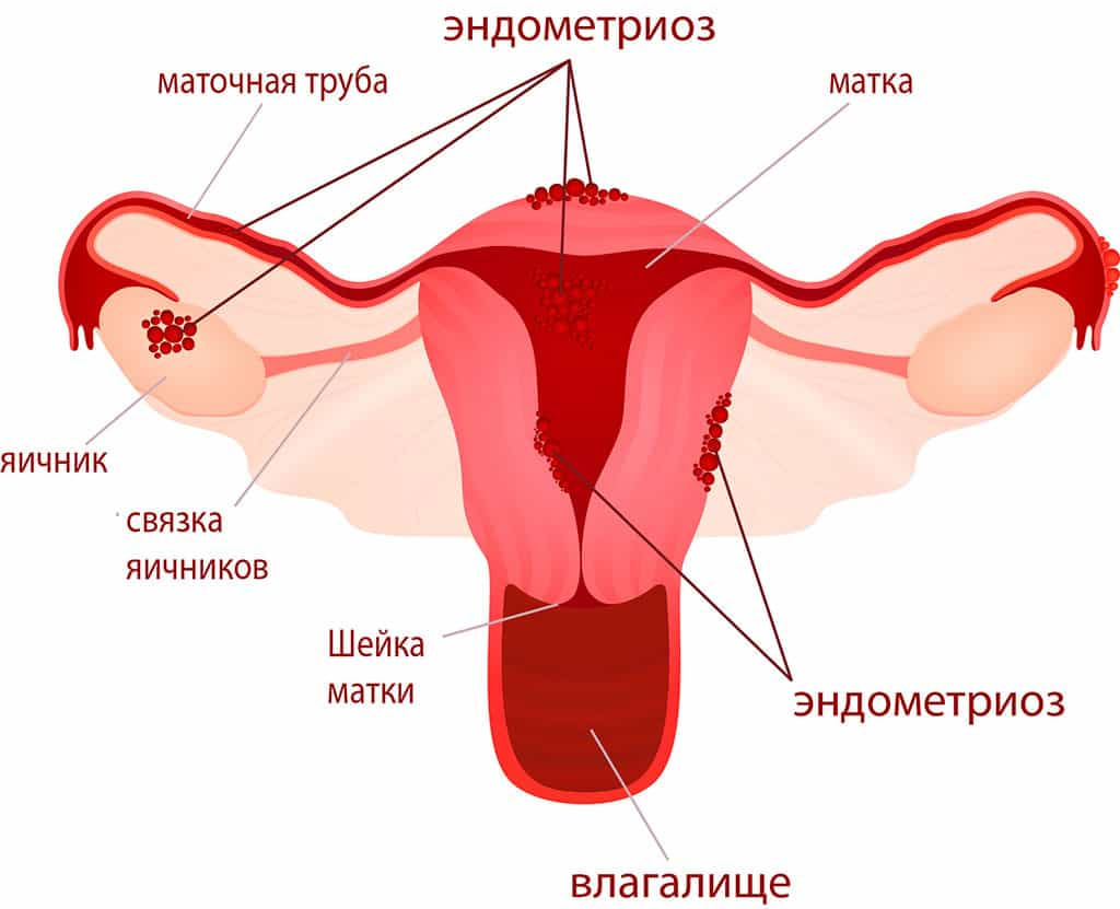 Эндометриоз: что это такое, как лечить, симптомы и виды в Минске